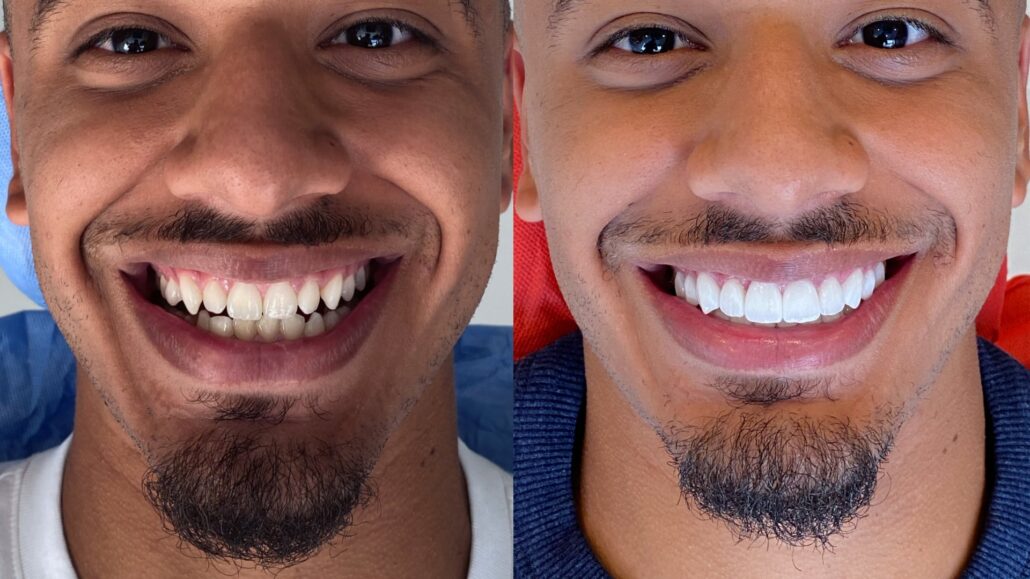 What is a Hollywood Smile Makeover or Smile Design?