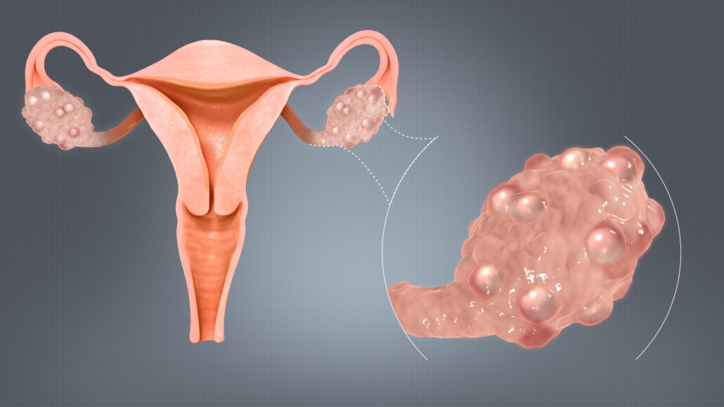 what every woman should know about polycystic ovarian syndrom