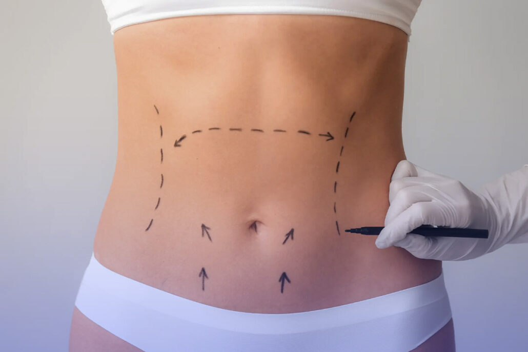 Tips for liposuction quick recovery