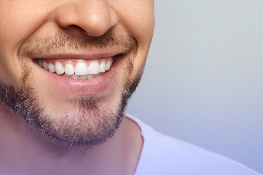 What is a Hollywood Smile Makeover or Smile Design?